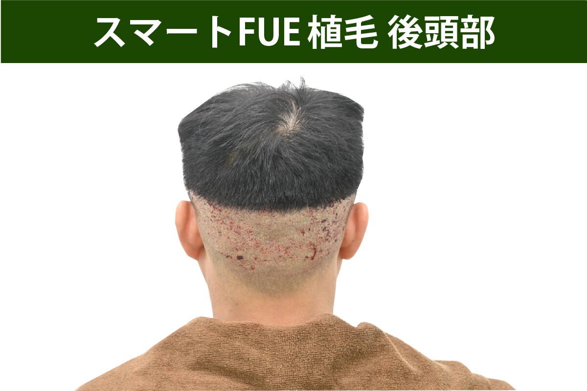 コストパフォーマンスとカミングアウトを前提とする「スマートFUE」