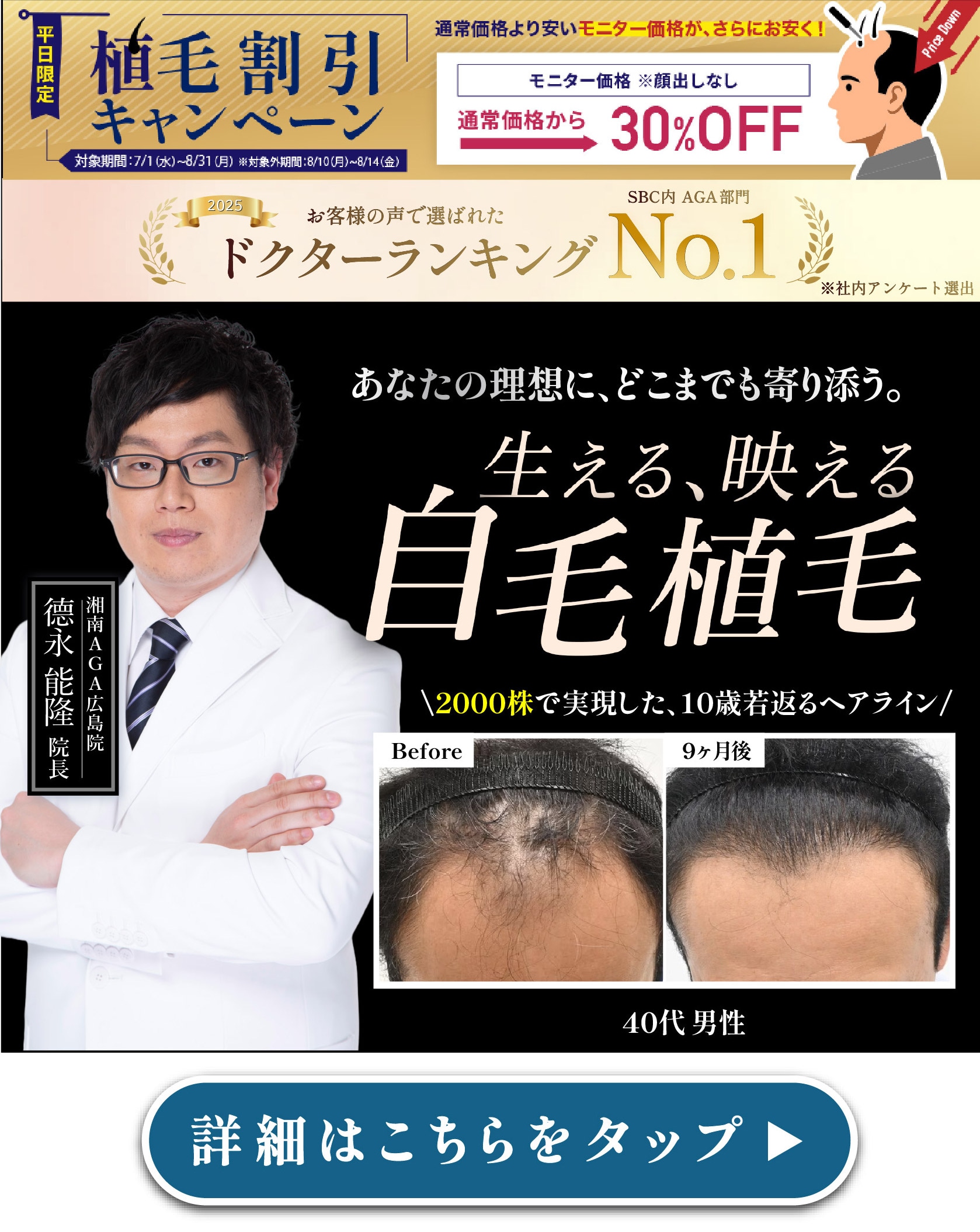 スマートFUE植毛モニター募集