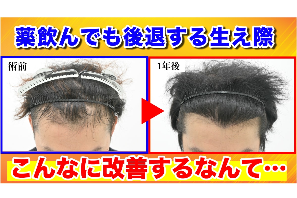 【広島】内服薬治療の限界から自毛植毛へ:40代男性・2000株で実現したM字改善の軌跡