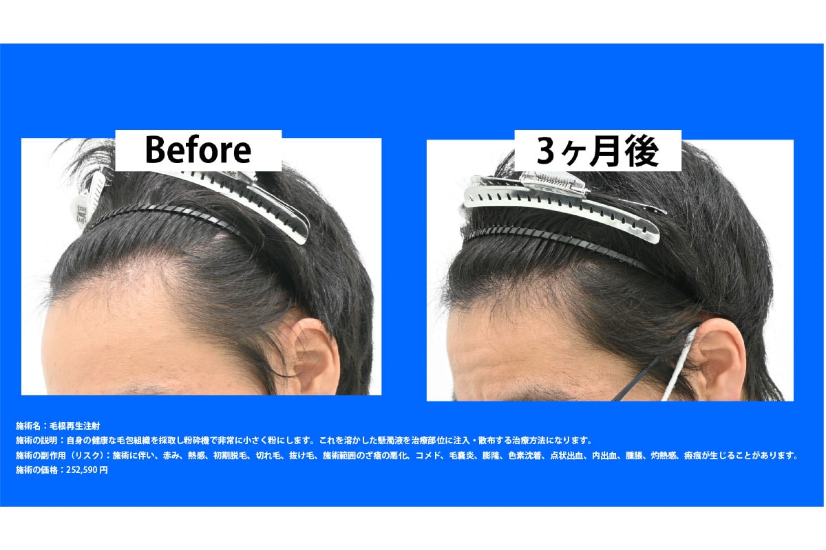 側頭部・こめかみの造形変化:ミッキーマウス型からの脱却<br />