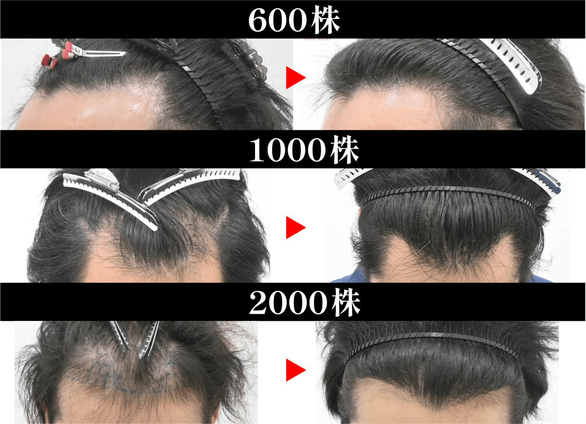 【症例紹介】徳永院長による自毛植毛の具体的な成果