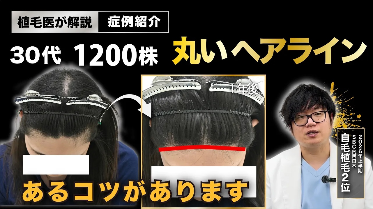 広島の自毛植毛で叶える「丸いヘアライン」：男性の理想のデザインと最新施術の工夫-湘南AGAクリニック広島院-