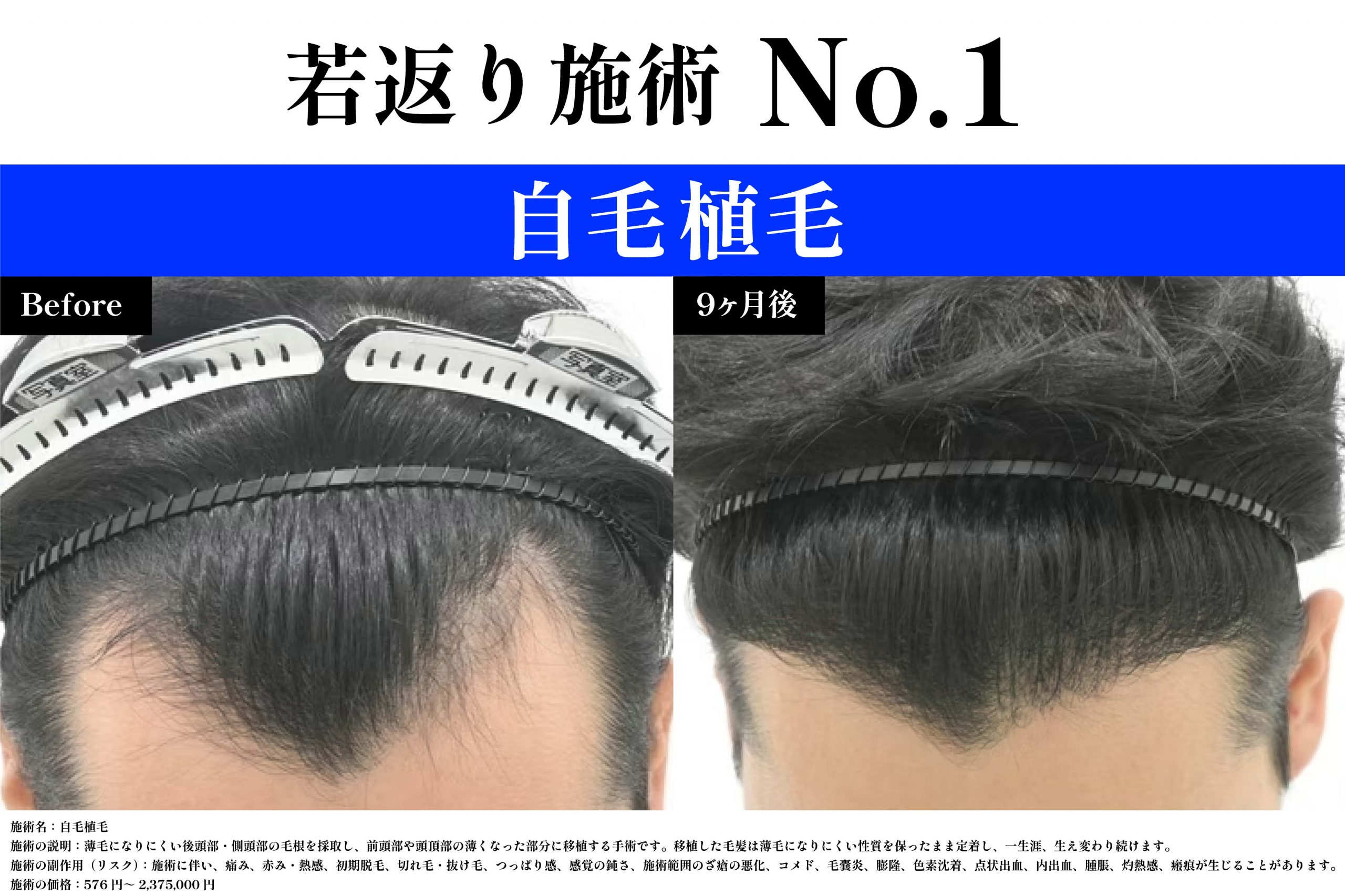 バレにくい・刈り上げない「高度な植毛メニュー」解説