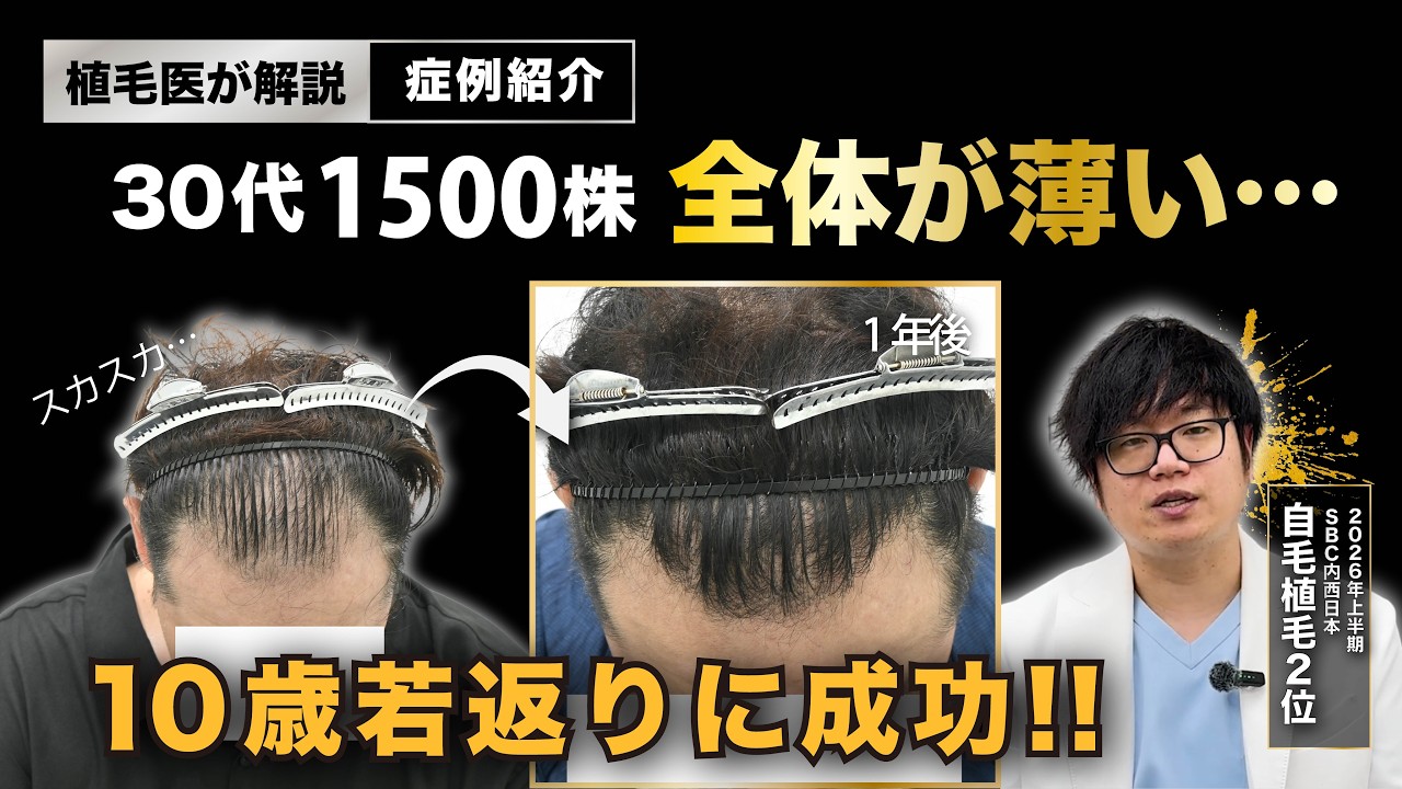 【スカスカ前髪…】自毛植毛で前髪はどこまで蘇る？-湘南AGAクリニック広島院-