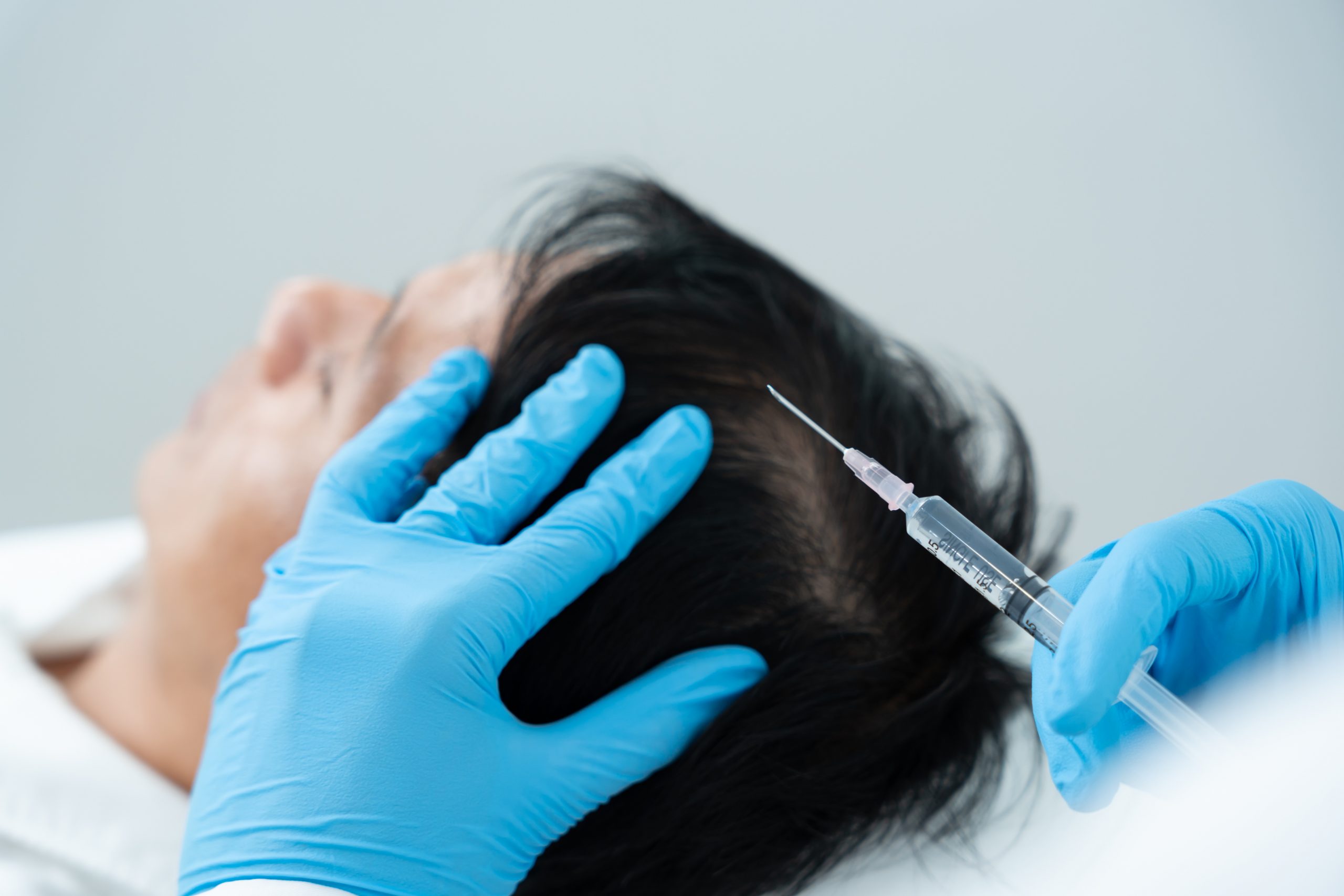 【生え際・頭頂部改善】髪を生やすための強い頭皮環境を作る