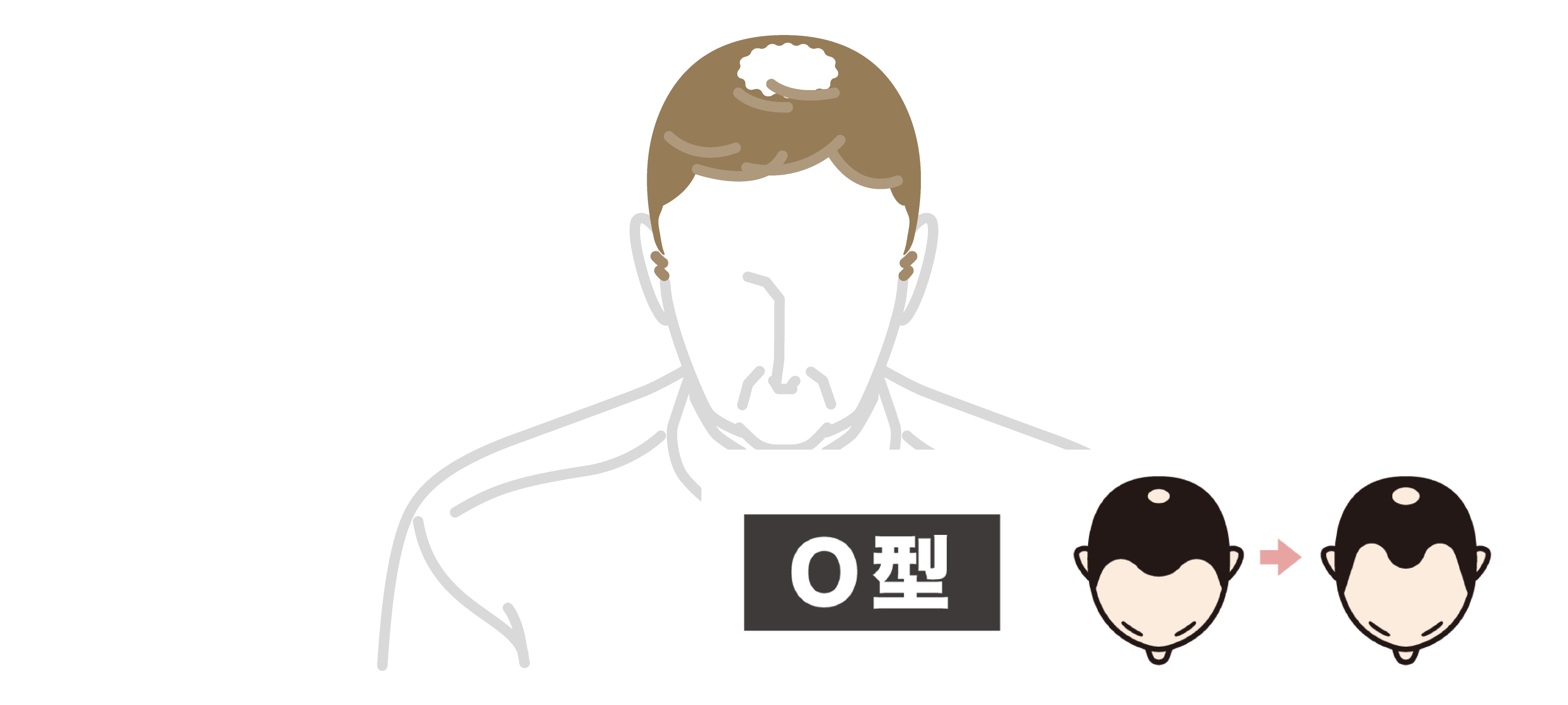 O型(頭頂部型)とは?