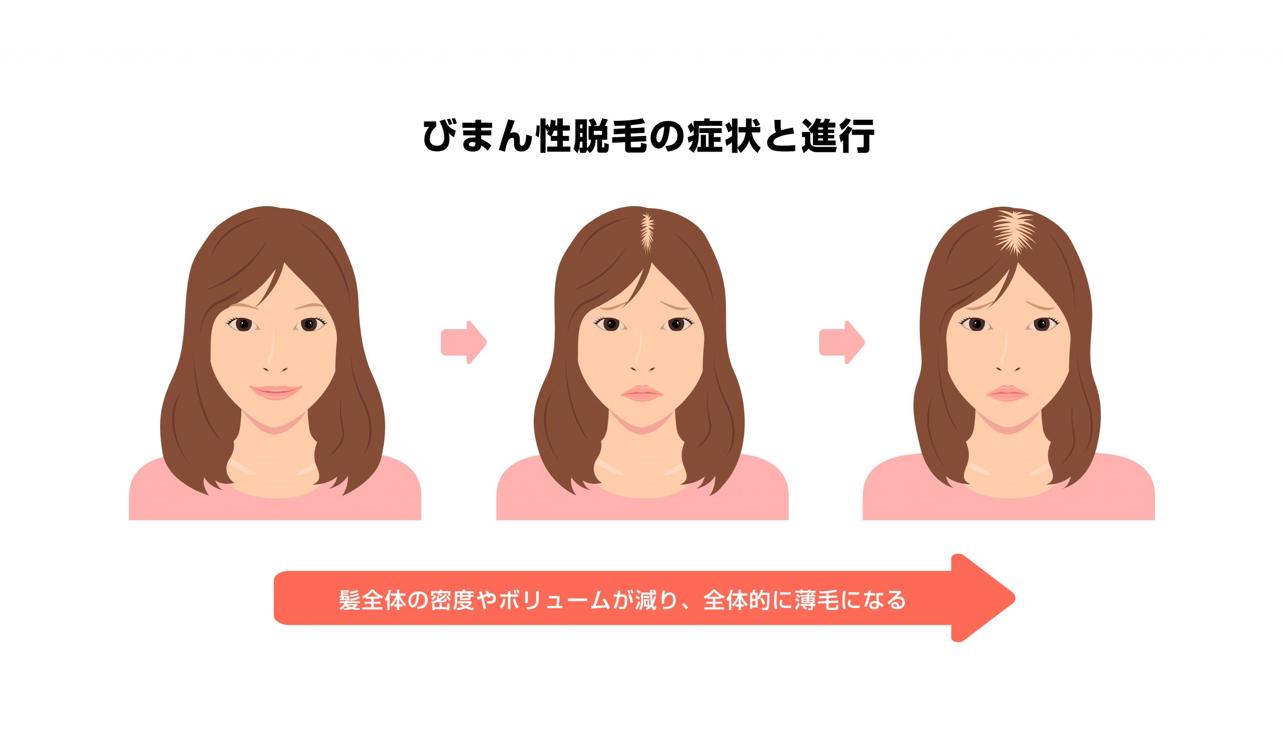 FAGA・びまん性脱毛症