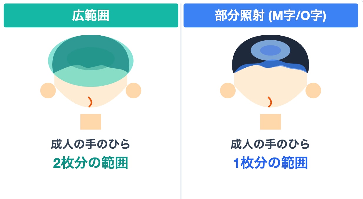 FoLixレーザー 照射範囲(広範囲・部分照射M字/O字)