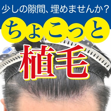 ちょこっと植毛で叶える理想のヘアスタイル