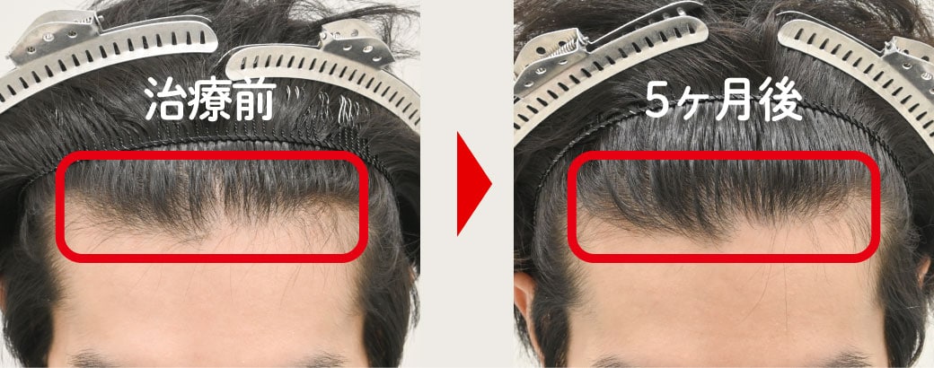 気になっていたM字の変化