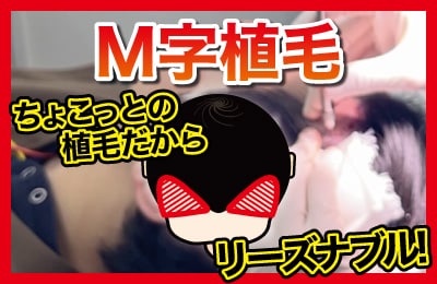 〈ちょこっと植毛でしっかり改善〉植毛でM字撃退！