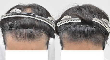 AGA治療薬＋毛根再生注射＋臍帯幹細胞上清液メソの症例写真 治療前と治療2ヶ月後の比較