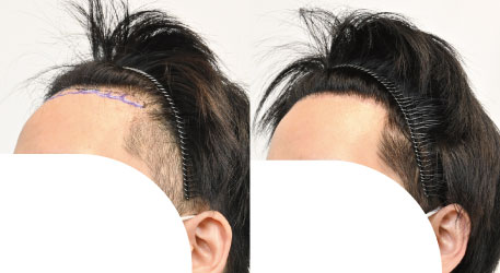 自毛植毛750Gの症例写真 治療前と治療1年後の比較