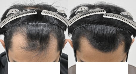 AGA治療薬＋毛根再生注射の症例写真 治療前と治療3ヶ月後の比較