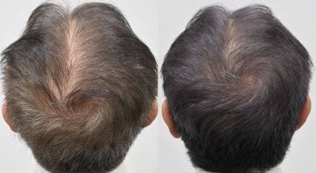 AGA治療薬＋毛根再生注射の症例写真 治療前と治療3ヶ月後の比較