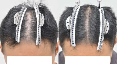 発毛レーザーFoLix＋エレクトロポレーションメソの症例写真 治療前と治療2ヶ月後の比較