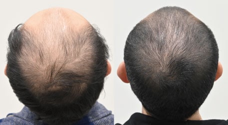 AGA治療薬＋毛根再生注射＋エレクトロポレーションメソ＋C-PRPメソの症例写真 治療前と治療10ヶ月後の比較