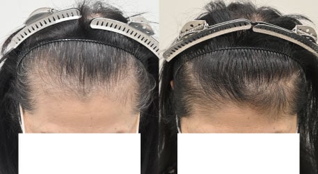 FAGA薬＋毛根再生注射＋エレクトロポレーションメソ＋C-PRPメソの症例 治療前と治療6ヶ月後の比較