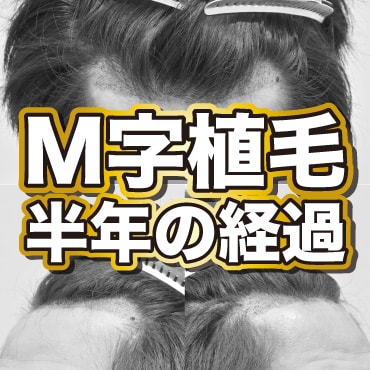 M字植毛の半年経過｜湘南AGAクリニック名古屋院症例 - 湘南AGA 