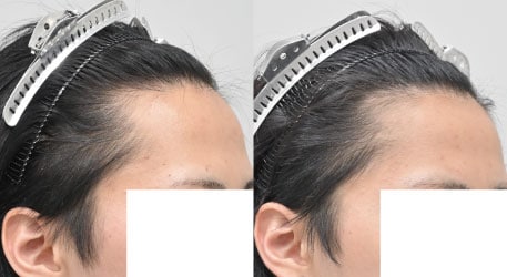 AGA治療薬＋エレクトロポレーションメソの症例写真 治療前と治療2ヶ月後の比較