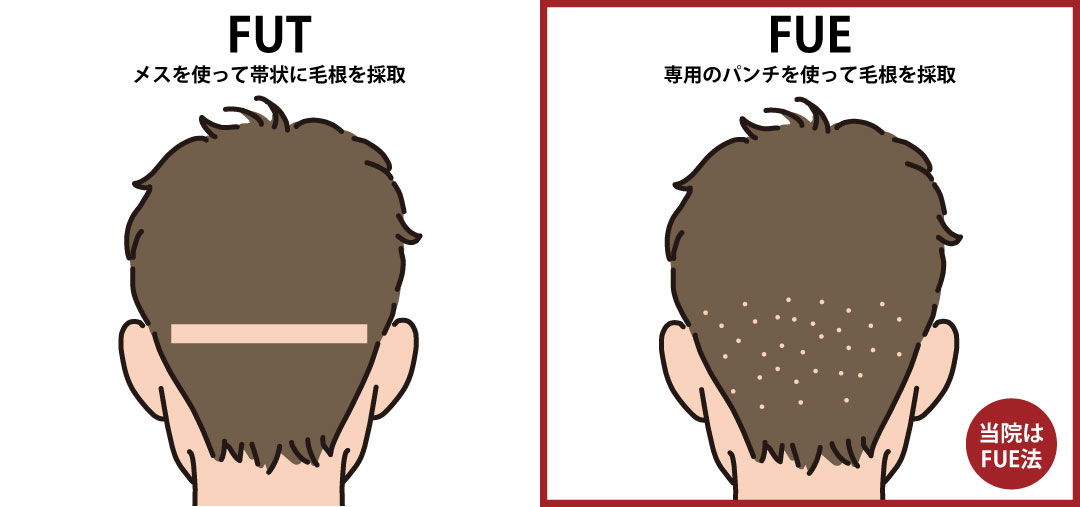 傷跡が目立ちにくい「FUE法」を採用
