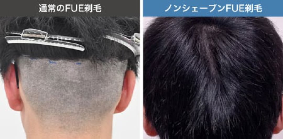 周囲にバレにくい「ノンシェーブン(刈らない)植毛」対応