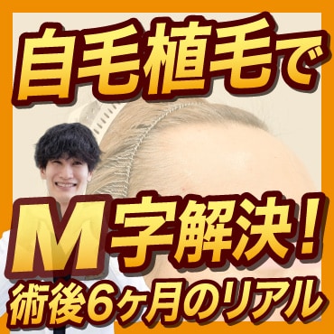 【M字改善症例】自毛植毛で自然な丸みのあるヘアラインへ！