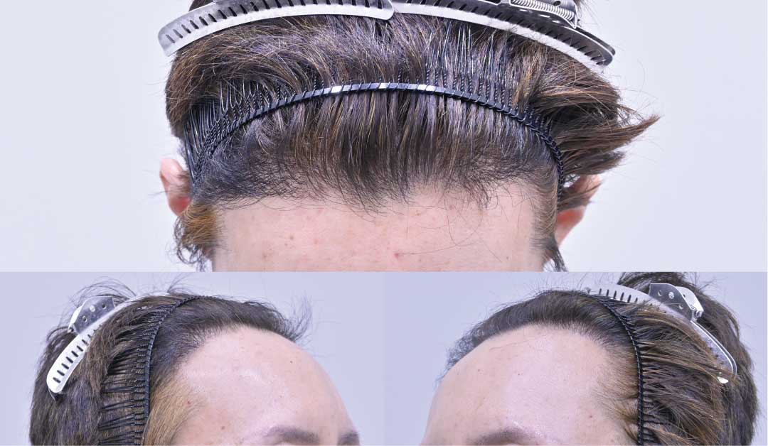 【術後6ヶ月目】毛髪が太く育ち、密度とヘアラインがしっかり形成！