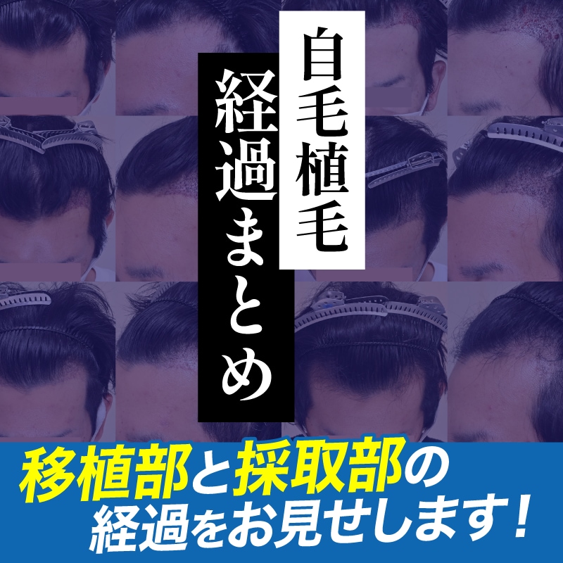 【保存版】写真でわかる自毛植毛のダウンタイム&経過まとめ