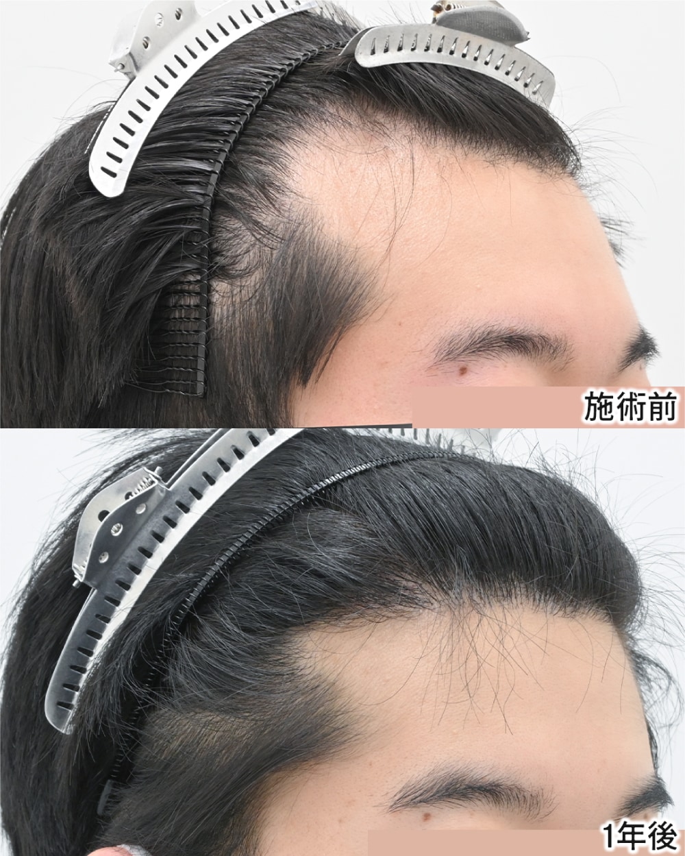 20代男性|自毛植毛 1,500グラフト