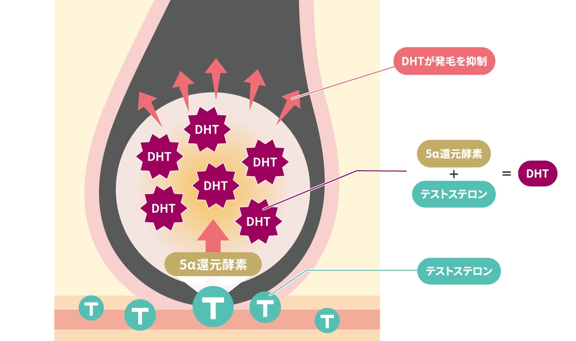 AGAの原因は男性ホルモン