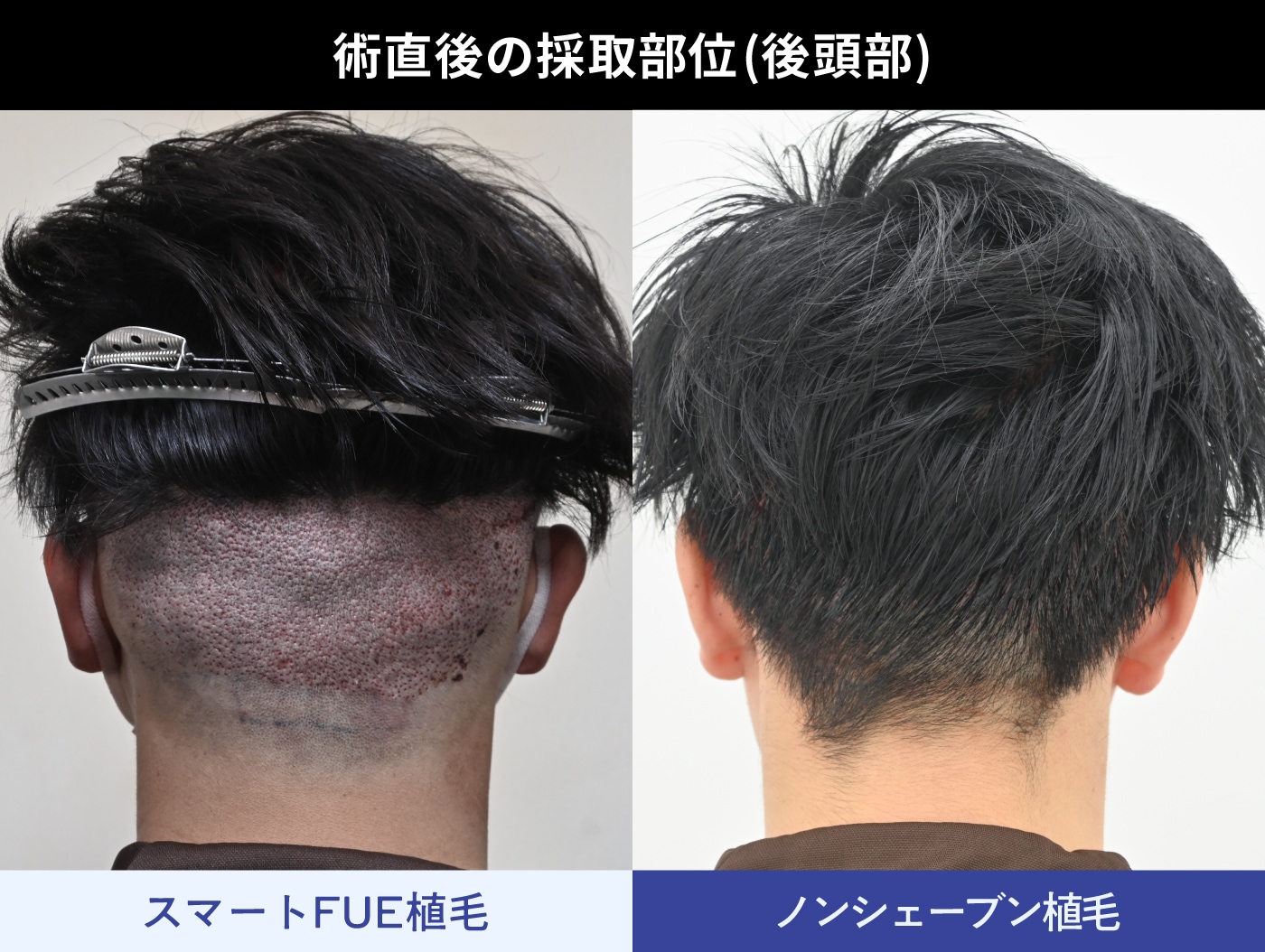刈り上げないからバレにくい「ノンシェーブン法」