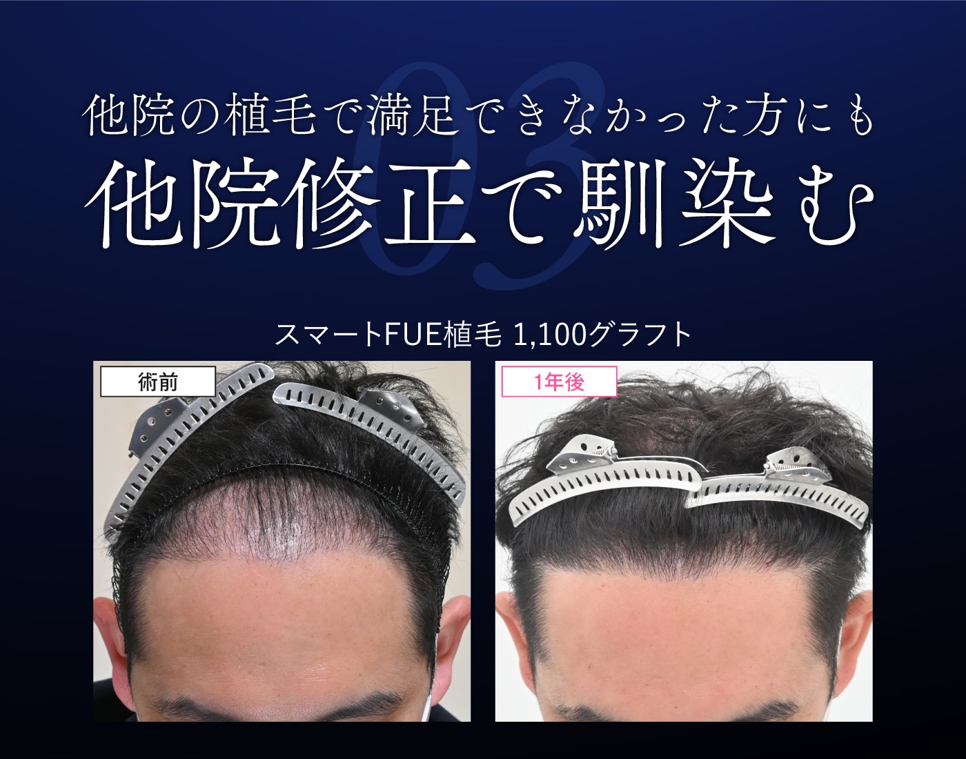 他院修正で馴染む