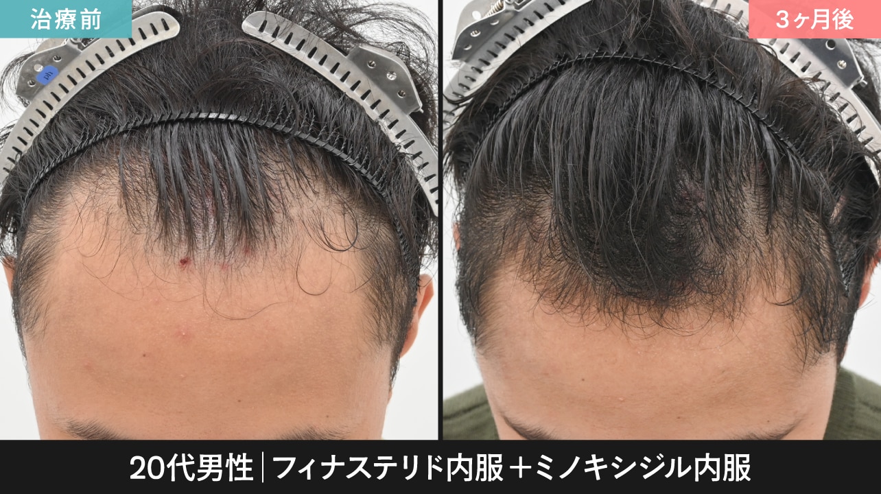 ミノキシジルとフィナステリドを併用した症例