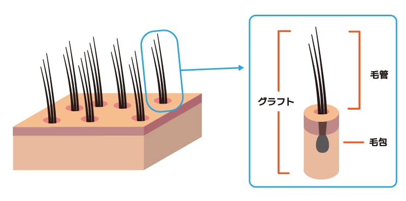 「グラフト」と「髪の毛の本数」の違い