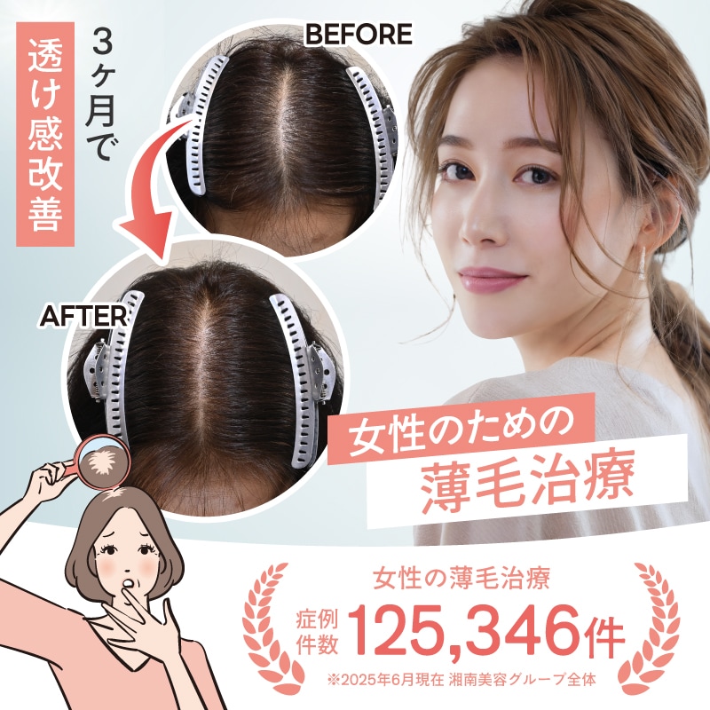 「分け目が目立つ…」女性のための後悔しない薄毛治療【大宮】