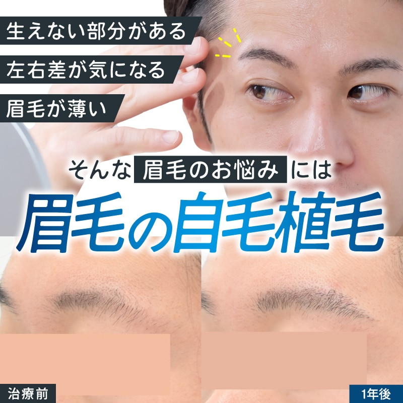 【メンズ眉毛植毛】毛がない部分にも自然に生える！自毛植毛で理想の眉をデザイン