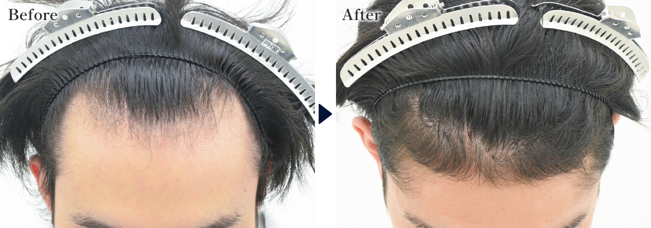 奥様に薄毛の指摘をされてご来院された方