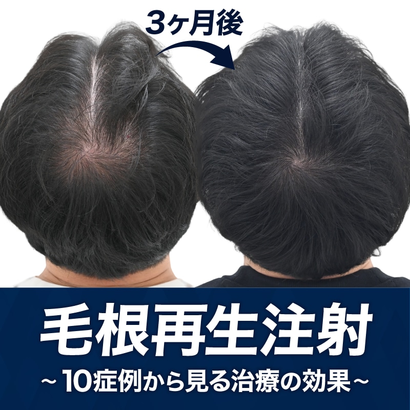 毛根再生注射は効果ある？｜10症例から見る治療効果