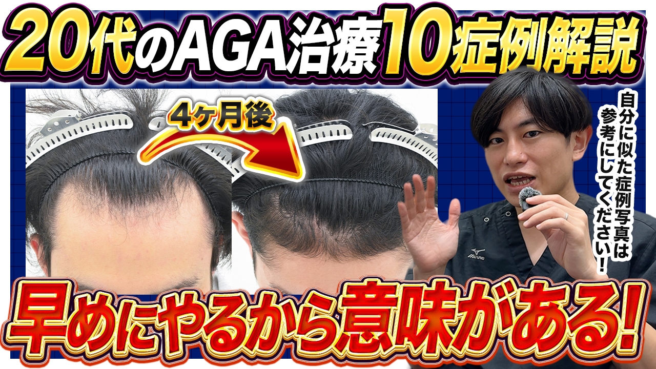 【医師解説】20代のAGA治療症例まとめ｜AGA治療症例から見る早期薄毛治療の重要性
