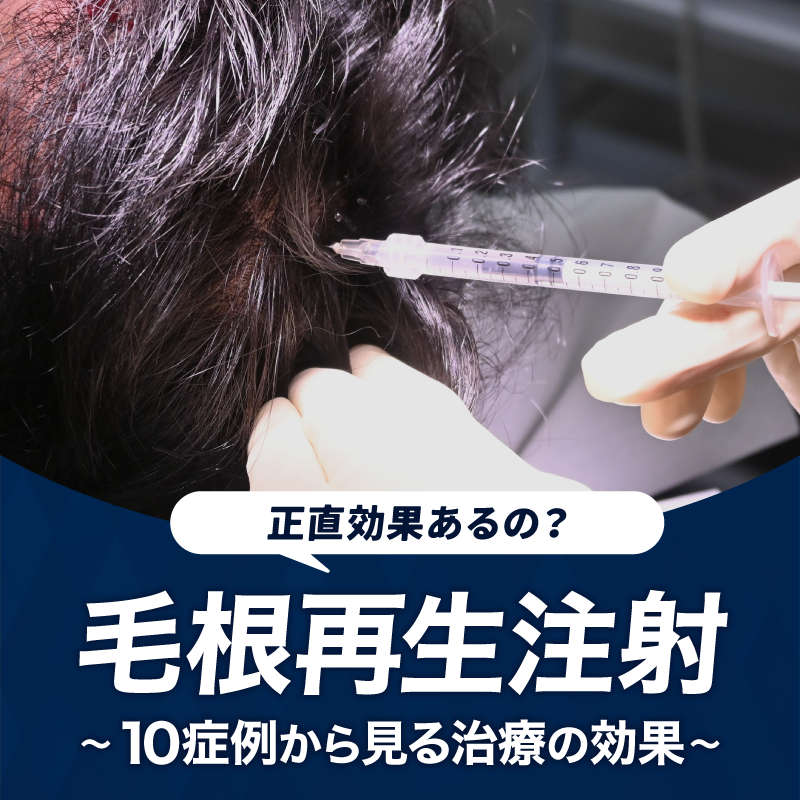 毛根再生注射は効果ある?|10症例から見る治療効果