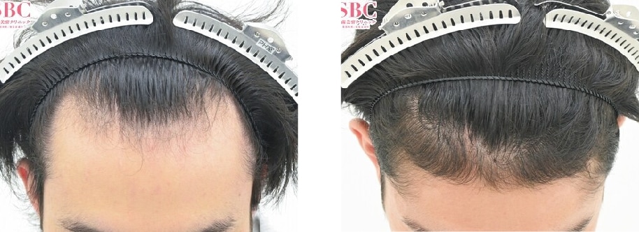【AGA薄毛治療】20代必見　薄毛は改善出来ます。薬と再生治療の4か月の変化