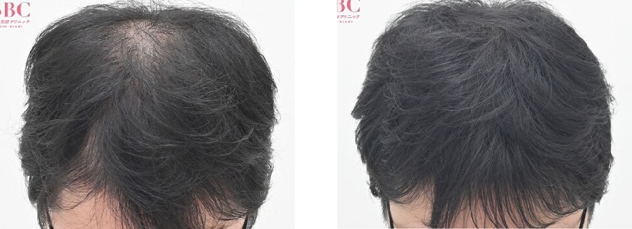 【AGA薄毛治療】再生医療で早期改善