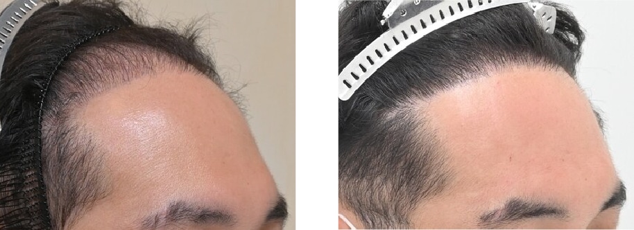 【AGA薄毛治療】二回目の手術で密度アップ