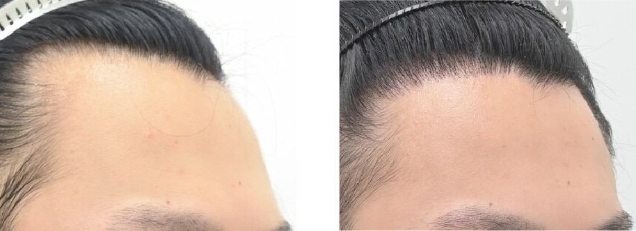 【AGA薄毛治療】生え際を狭くする自毛植毛
