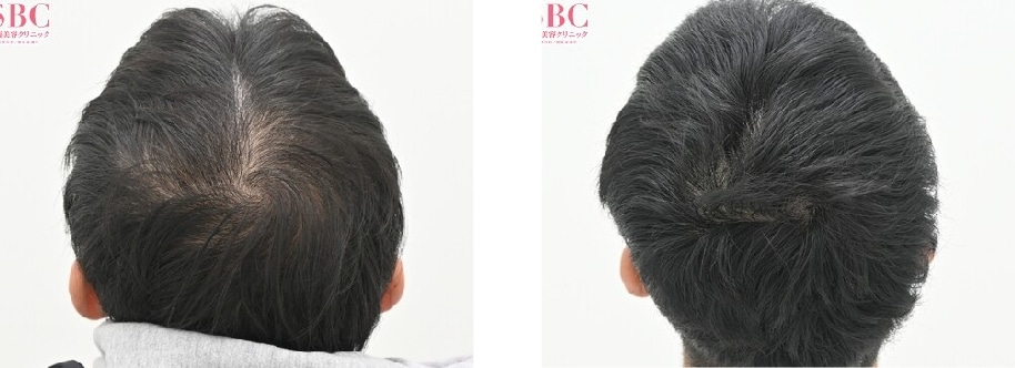 【AGA薄毛治療】20代の薄毛の悩みを改善　毛根再生注射と臍帯幹細胞メソセラピー