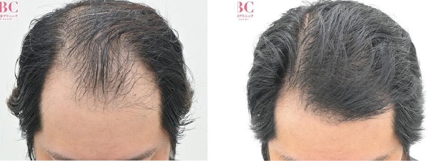 【AGA薄毛治療】毛根再生注射と臍帯幹細胞上清液メソで劇的変化