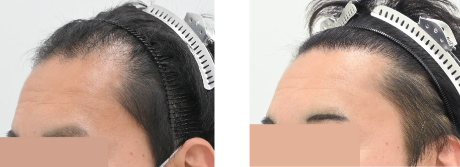 【AGA薄毛治療】自毛植毛でM字改善1500グラフトの変化