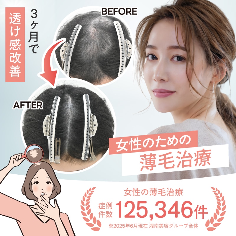 「分け目が目立つ…」女性のための後悔しない薄毛治療【大宮】