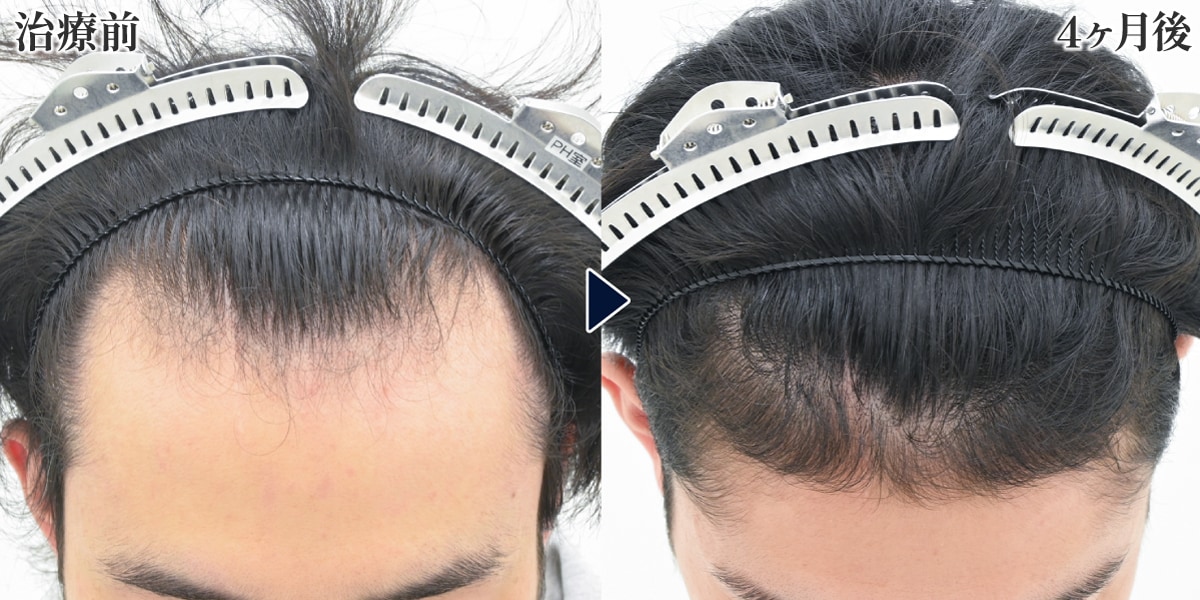 症例写真で見る再生治療